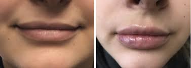 Dangers and Side Effects of Lip Fillers post thumbnail image