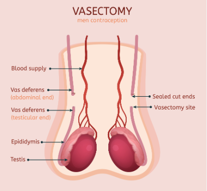 Saskatoon’s Guide to Vasectomy Reversal: Options and Resources post thumbnail image
